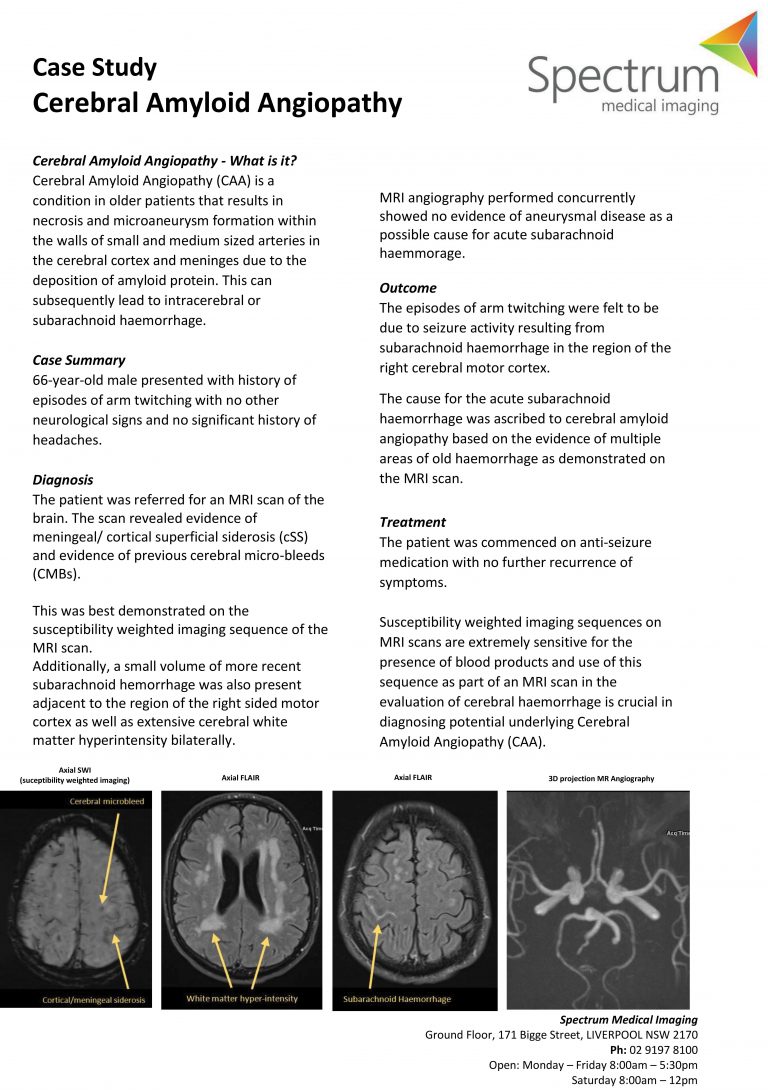 Cerebral Amyloid Angiopathy – a real case study – GP Voice
