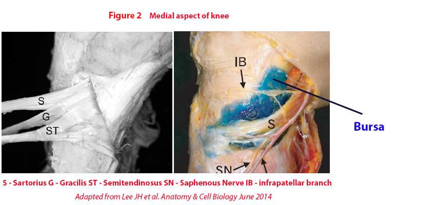 pes anserinus tendinitis