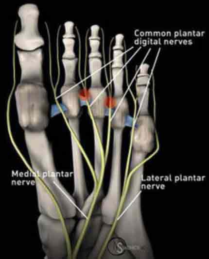 Morton s Neuroma A Case Study GP Voice