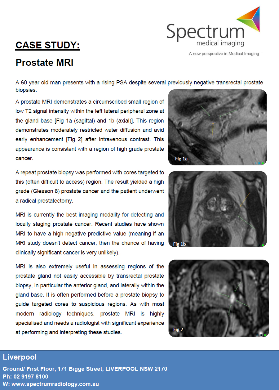 Prostate MRI A Case Study GP Voice