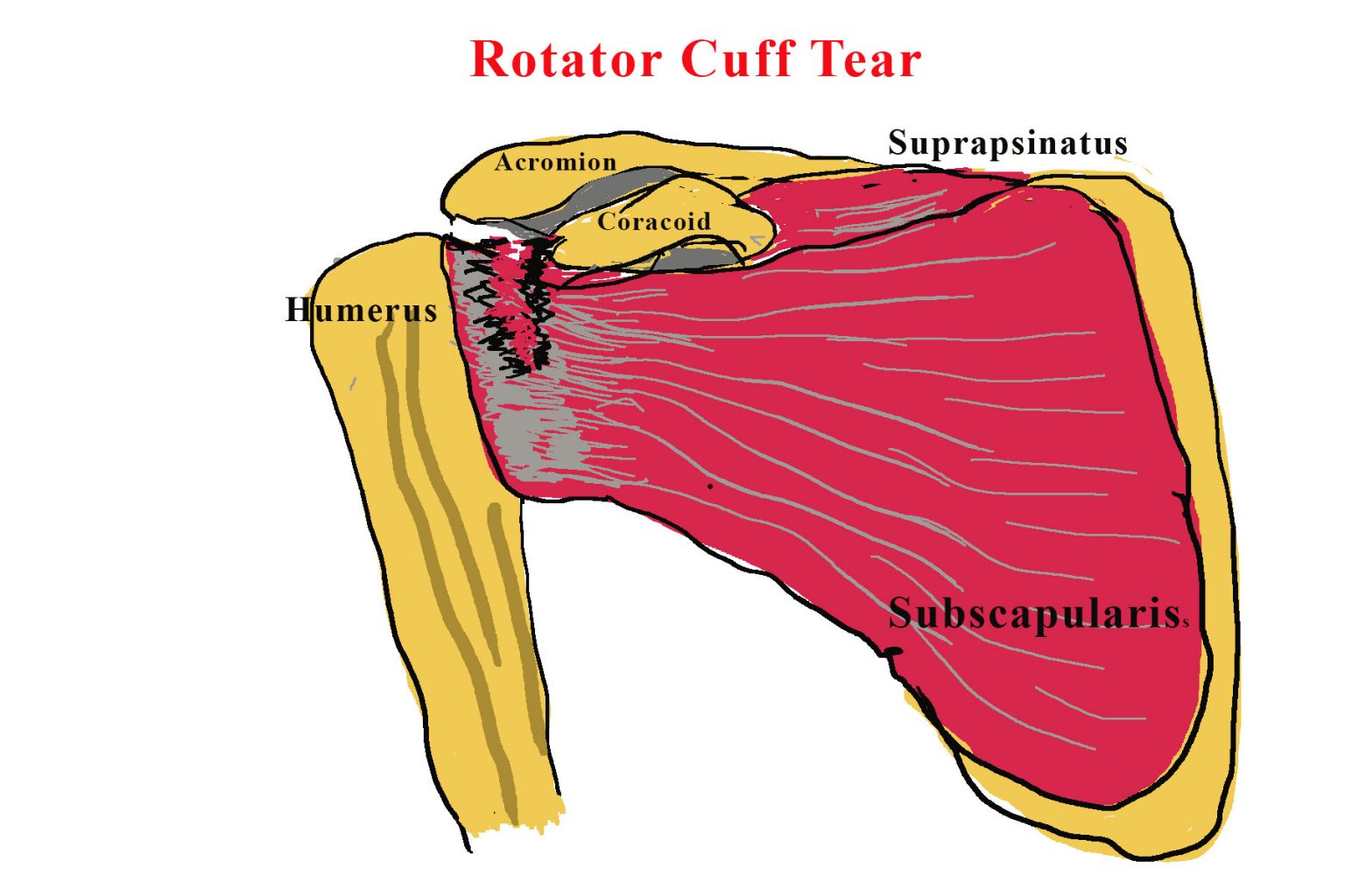 Rotator Cuff Tears Do Steroid Injections Work Gp Voice 7364