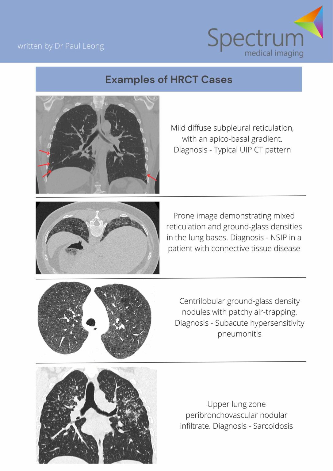 High Resolution CT Chest – when to order one – GP Voice