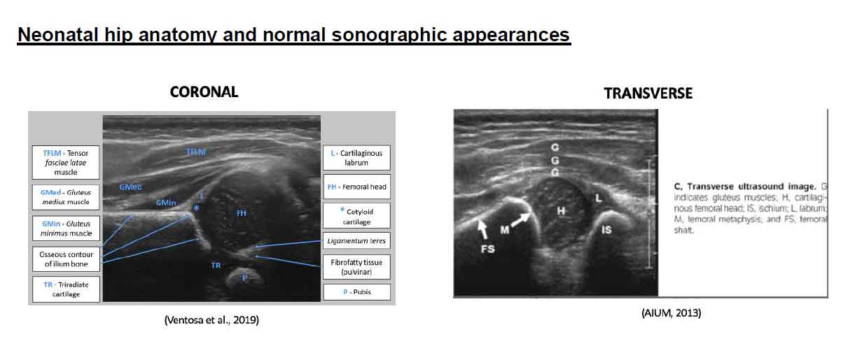 Paediatric ultrasound – developmental hip dysplasia – GP Voice